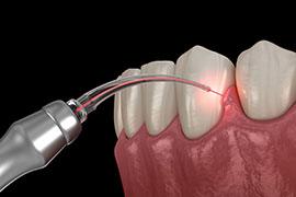 Illustration of laser being used to treat gums