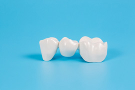 Dental bridge casting a slight shadow on blue surface