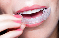 Mouth applying clear braces