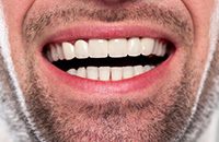 Smiling mouth with corrective crowns