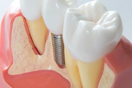 model of dental implant