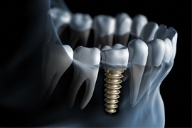 Animation of implant supported dental crown