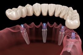 implant-retained denture