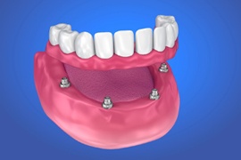 implant-supported denture