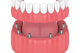 denture and dental implants