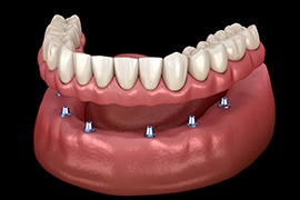 a graphic illustration showing an implant bridge