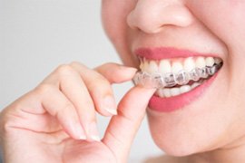 Closeup of patient putting Invisalign aligners on