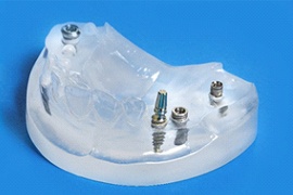 Multiple dental implants