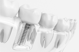 Model of implant and jaw