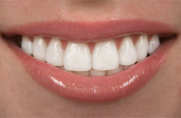 A closeup of a brilliantly white smile.