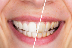 Before and after teeth whitening