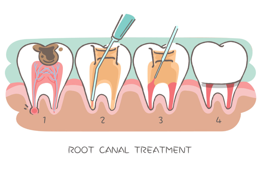 illustration of root canal 