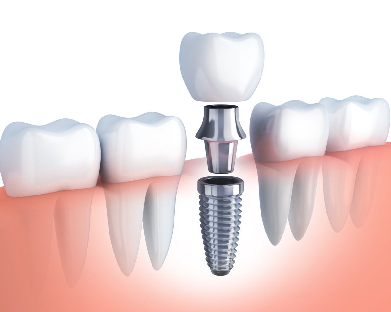 Dental implant in row of teeth